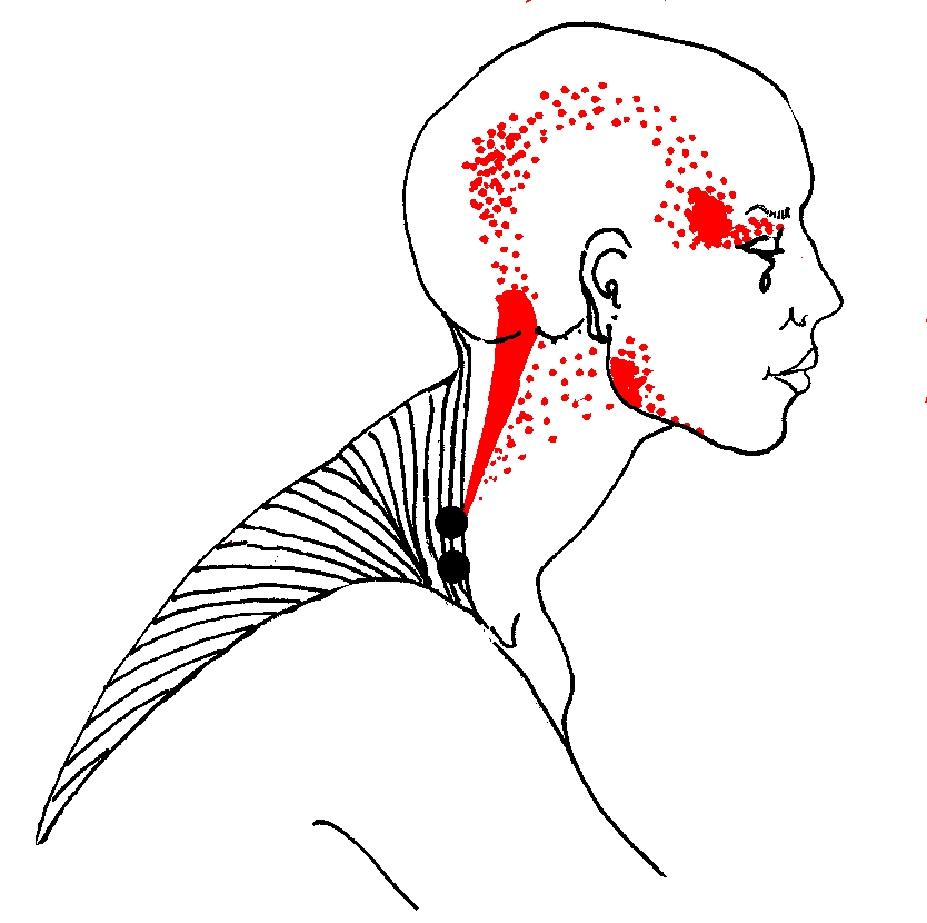 Trigger Points For Headaches Chart